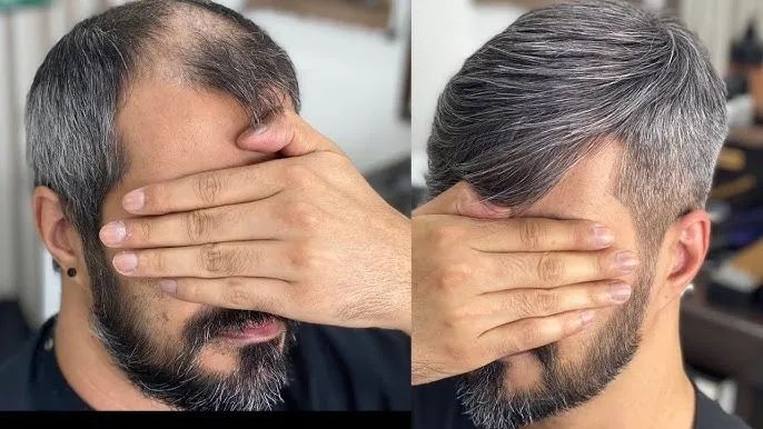 Prótese Capilar Masculina - Foto 2