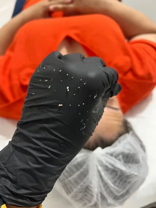 Limpeza de pele Enzimática - Foto 2