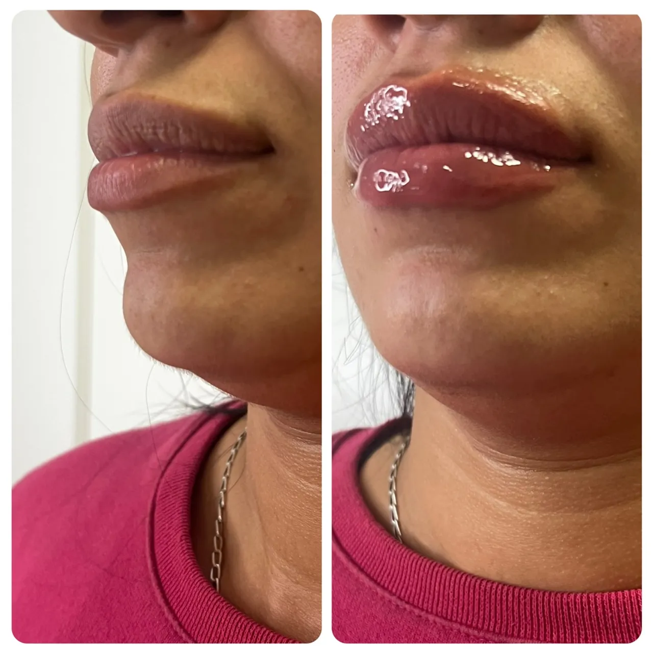 Lip Filler Antes e Depois