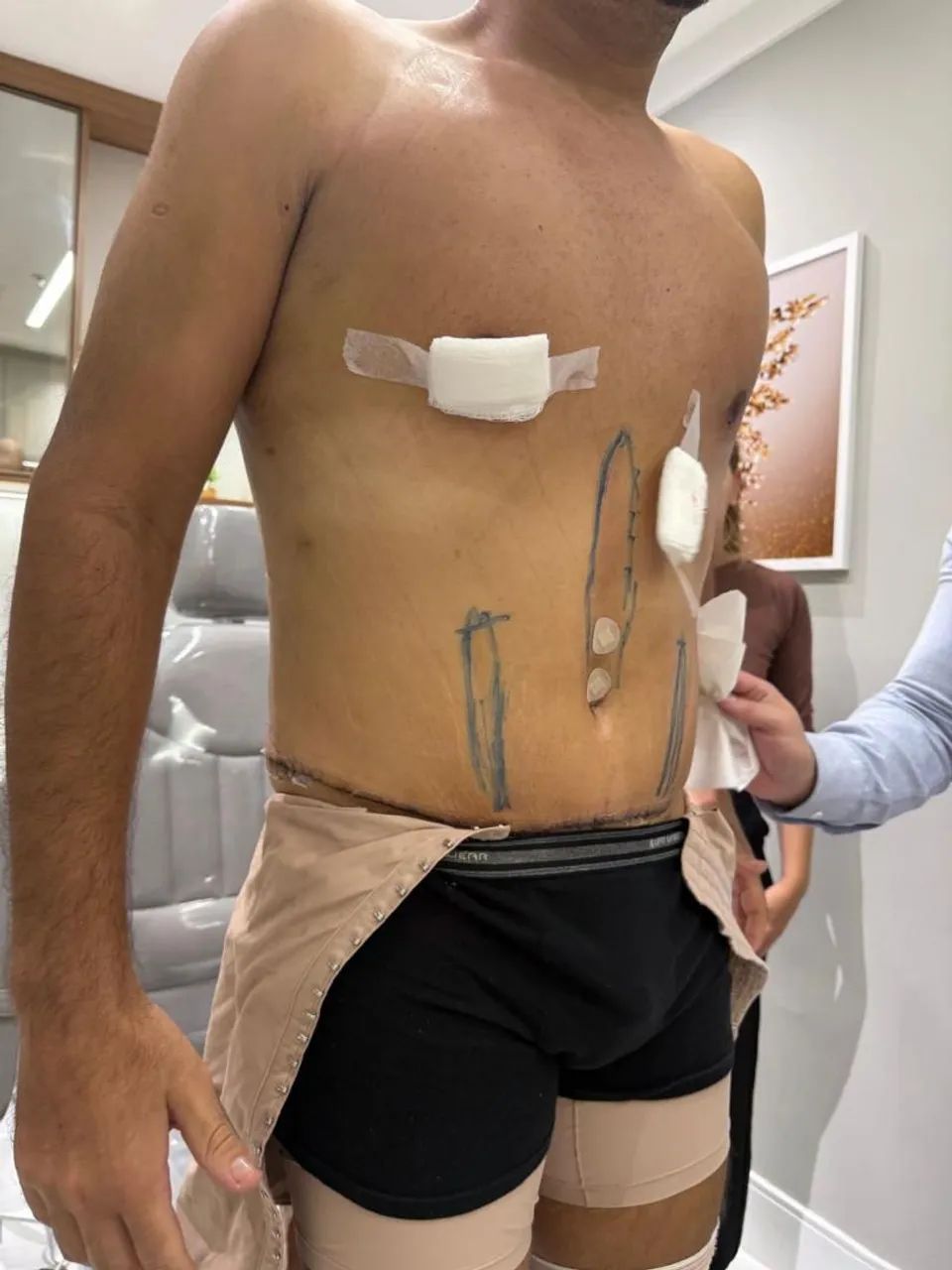 Pós-operatório de Cirurgia Plástica - Foto 5