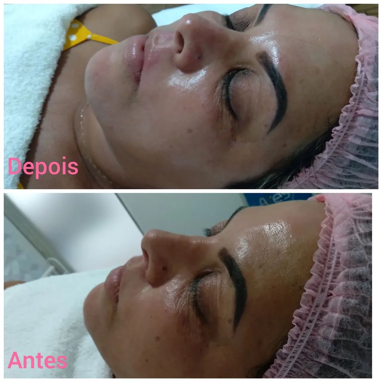 Limpeza de pele facial  - Foto 3
