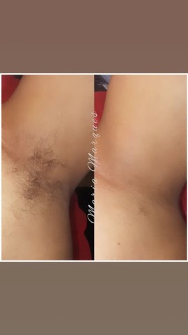 Depilação feminina e masculina - Foto 3