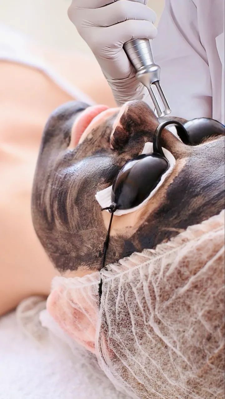 Peeling de Hollywood com Laser - Tratamento Estético Facial