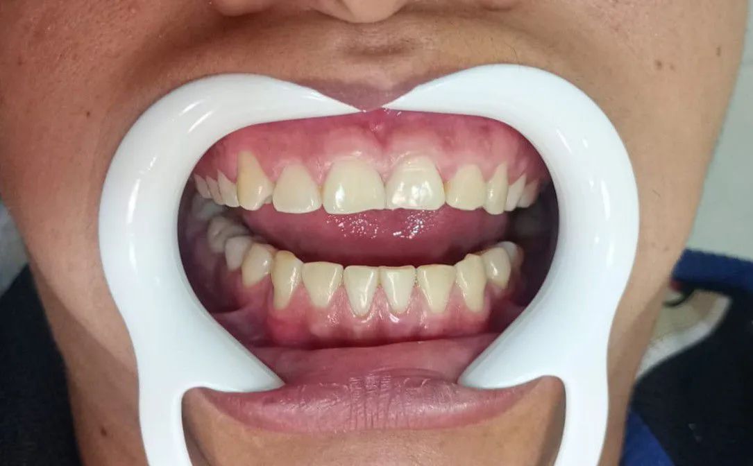 Clareamento dental - Foto 2