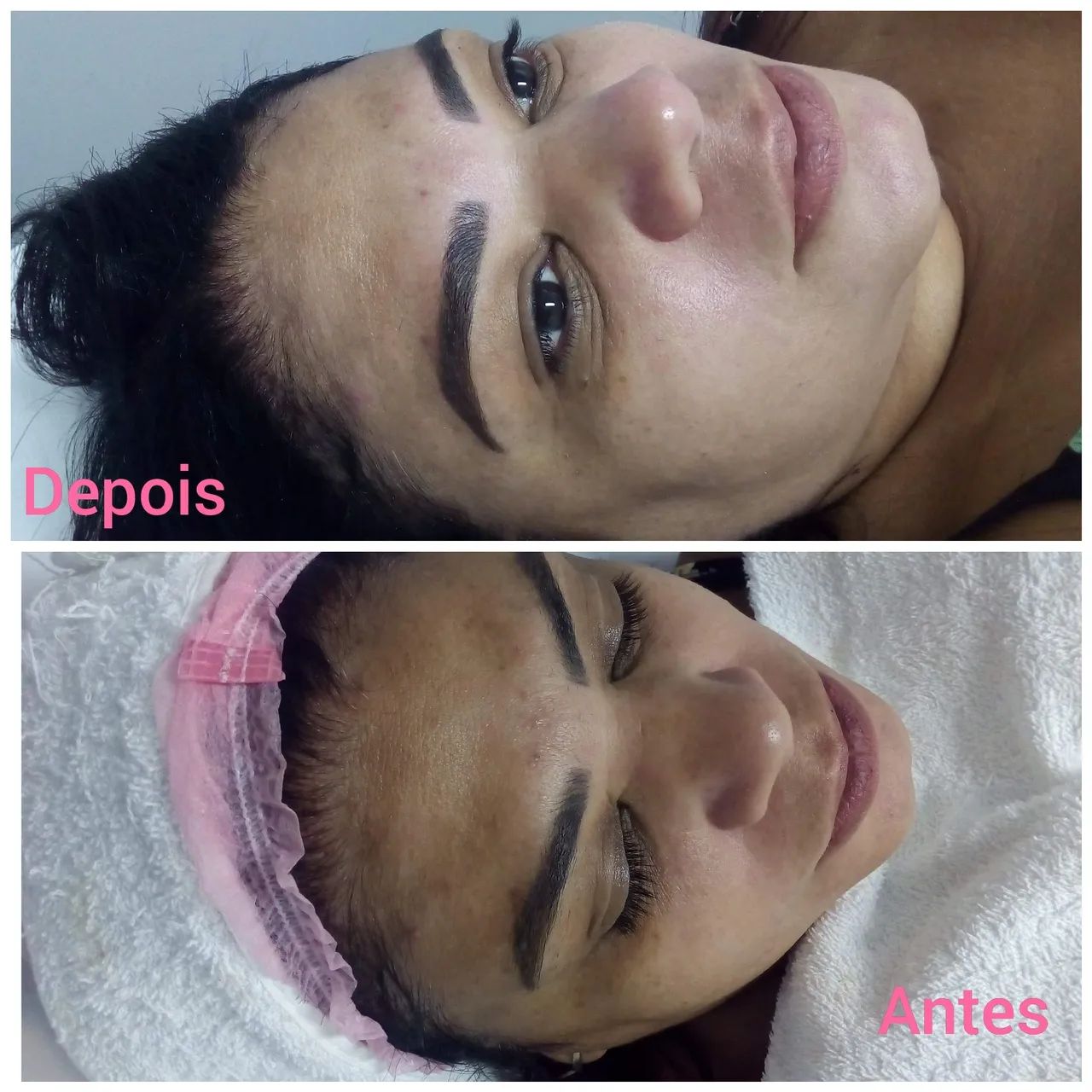 Limpeza de pele facial  - Foto 4