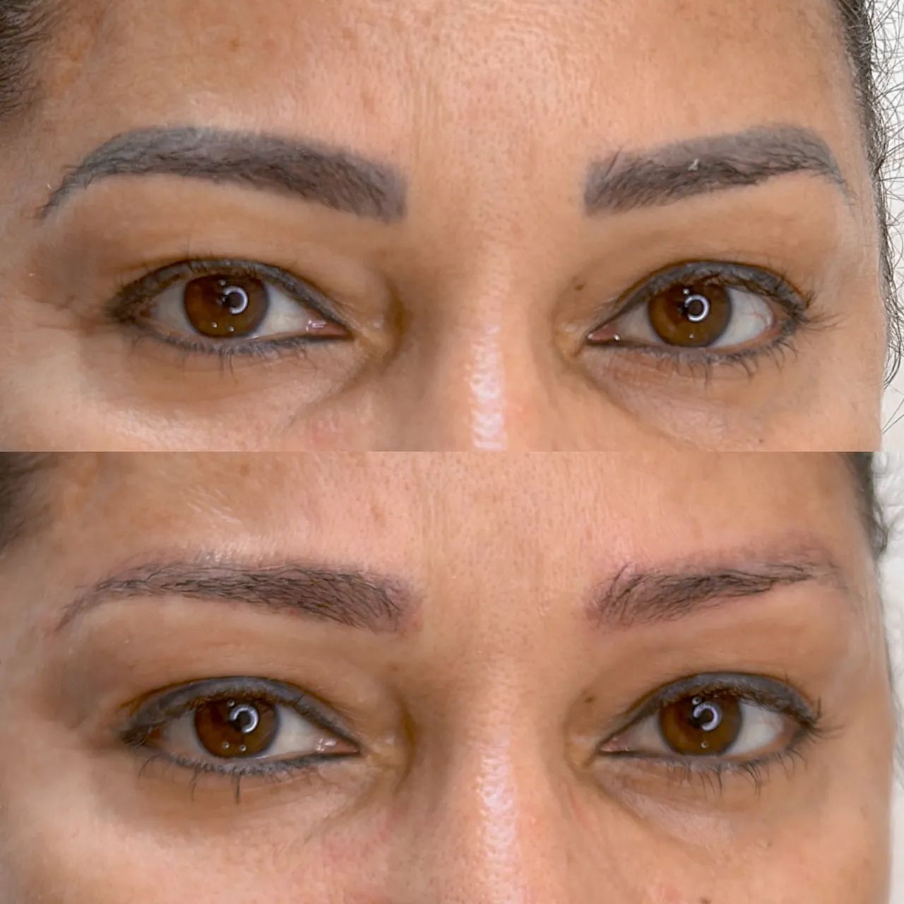 Remoção a laser de micropigmentação