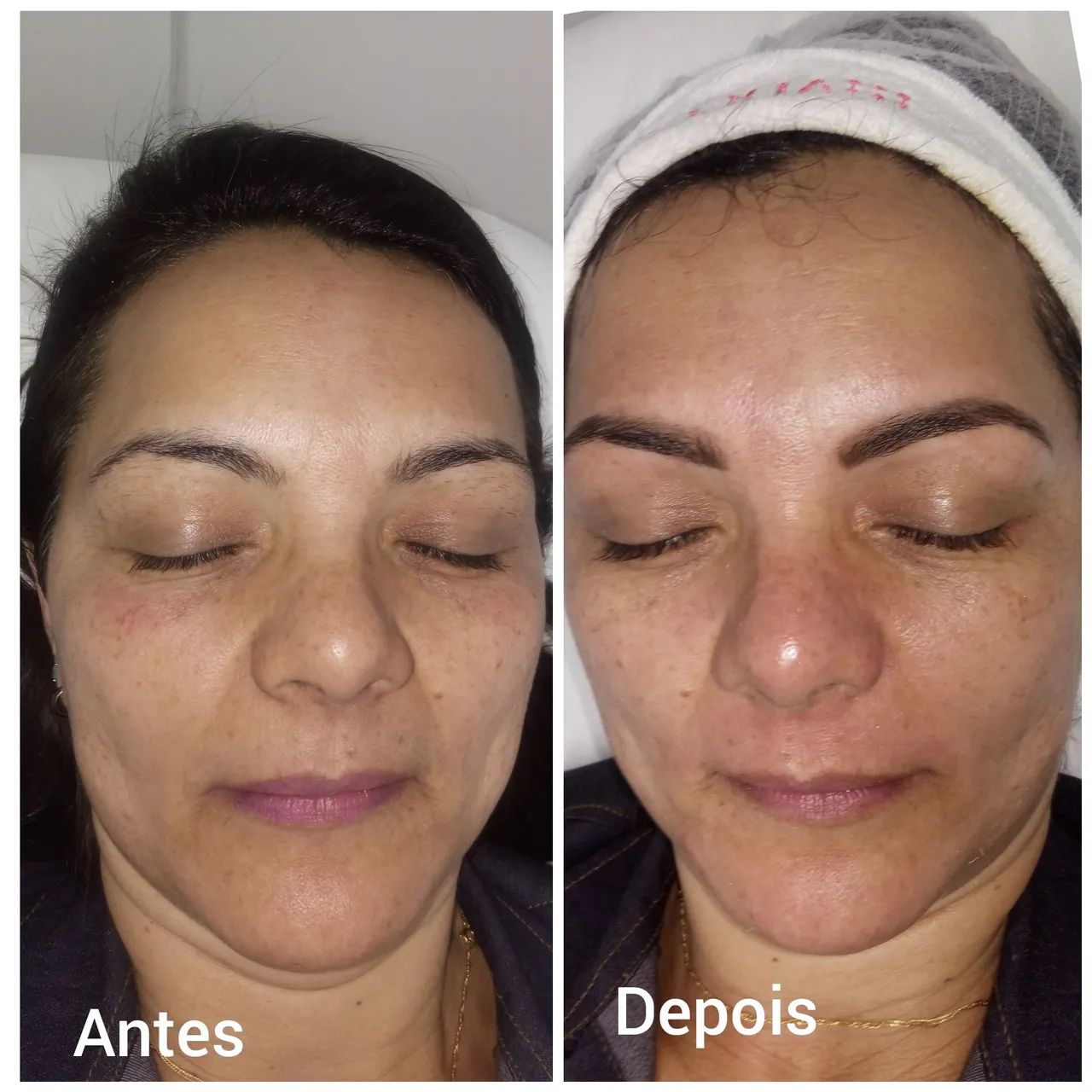 Limpeza de pele facial  - Foto 5