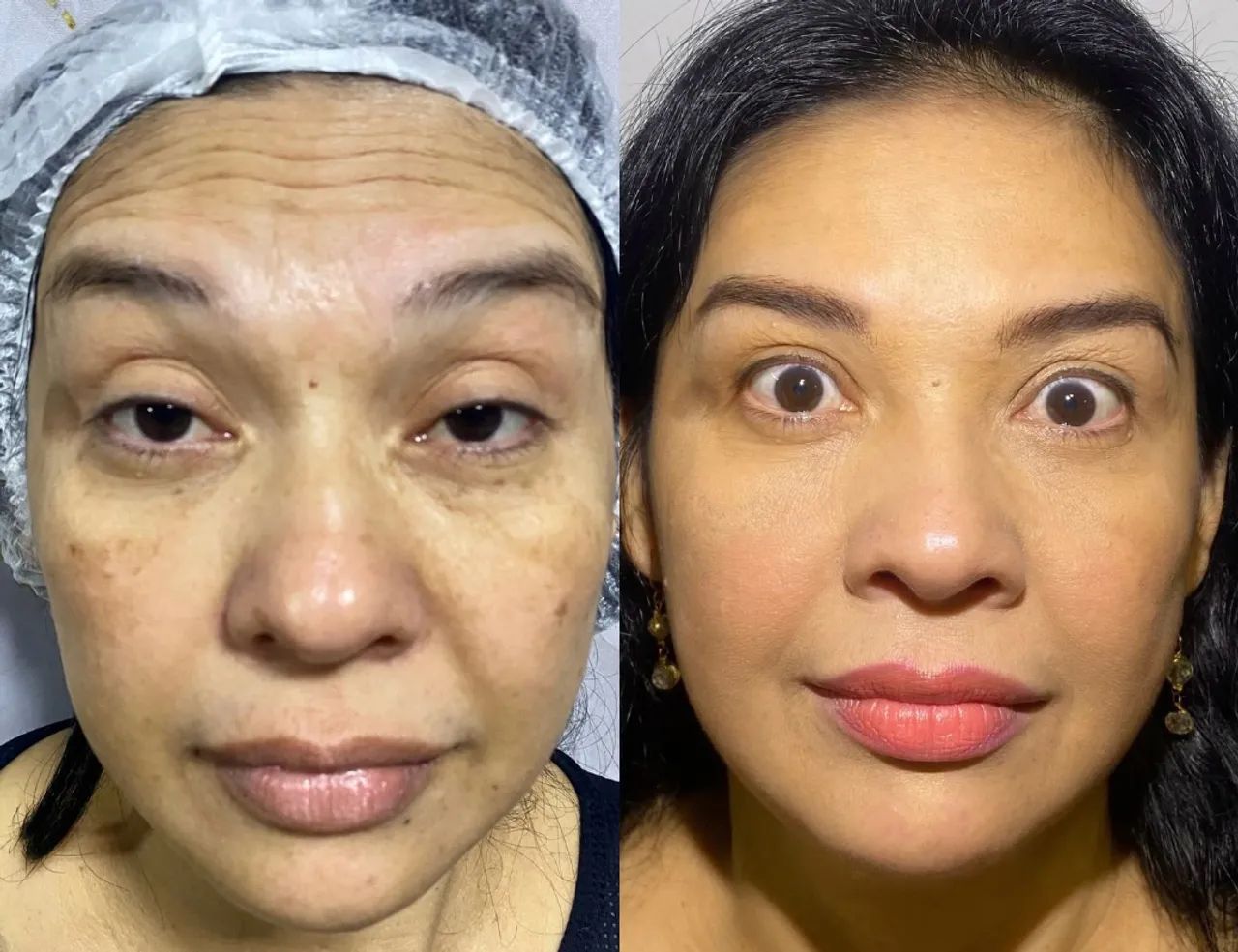 VAGAS PACIENTES MODELOS PARA PREENCHIMENTO LABIAL E BOTOX - Foto 5