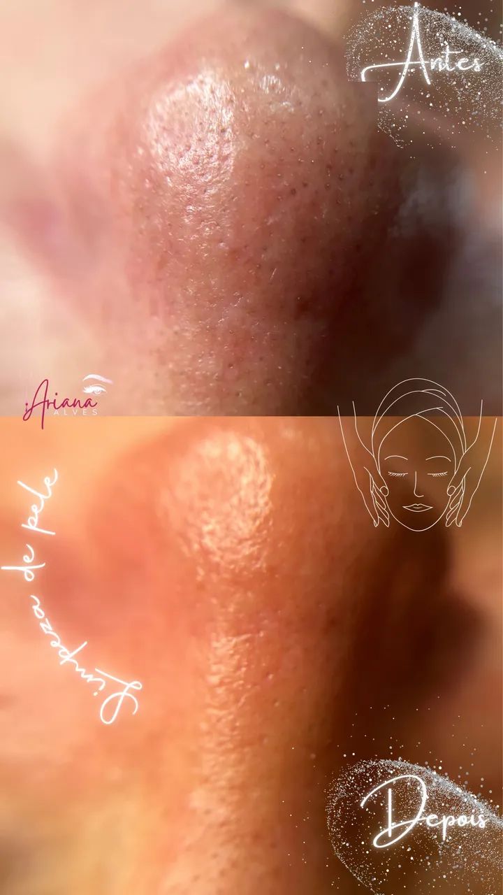 Limpeza de pele + Spa dos lábios  - Foto 3