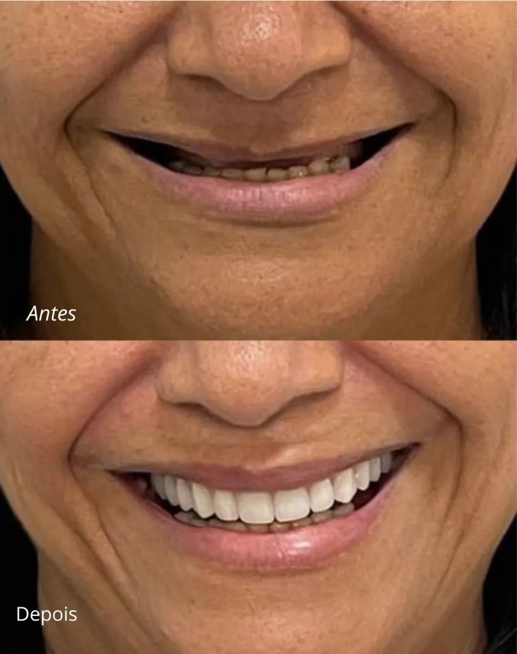 #Proteses Dental em Fortaleza  - Foto 2