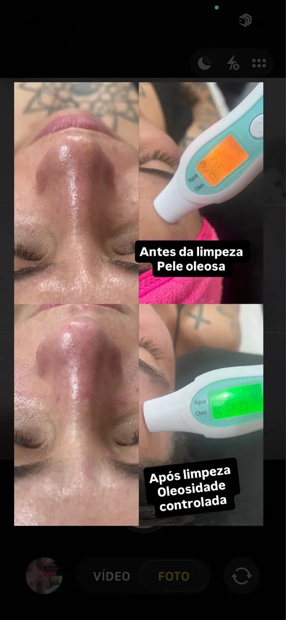 Limpeza de pele profunda completa  - Foto 5