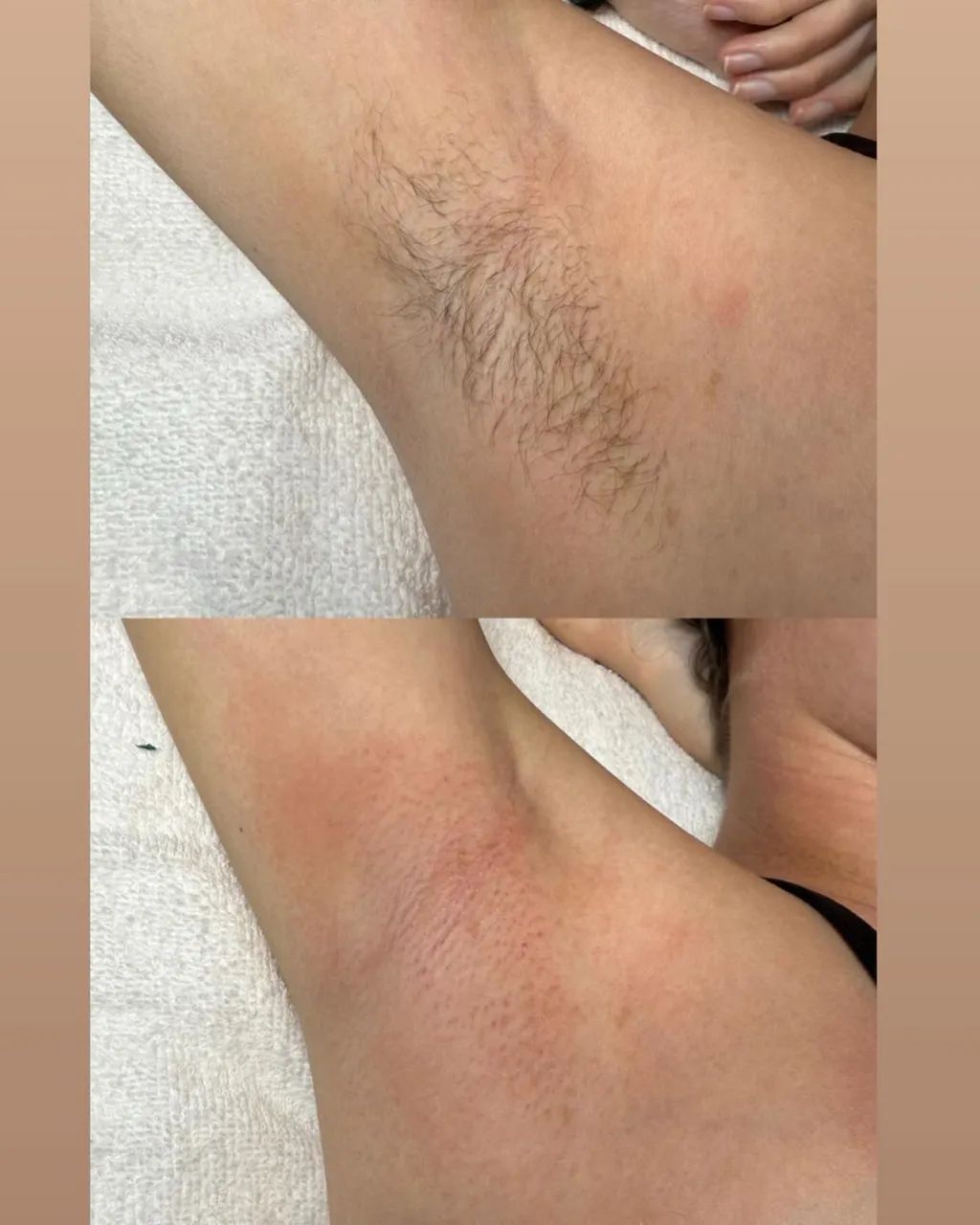 DEPILAÇÃO  - Foto 2