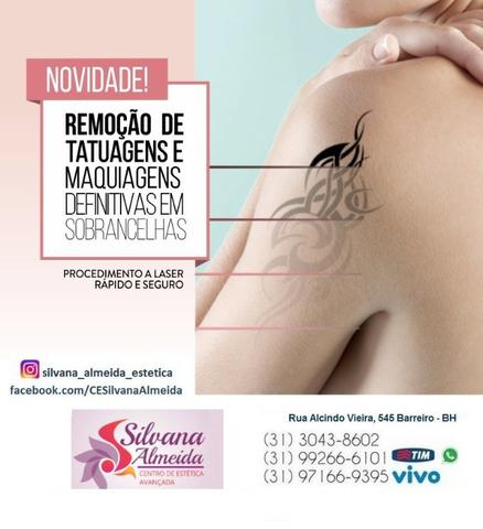 Remoção de Tatuagem à laser em Floripa apagar tatuagem em Floripa - Foto 2