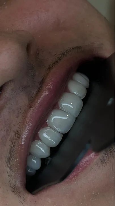 Facetas em Resina Premium - Foto 2