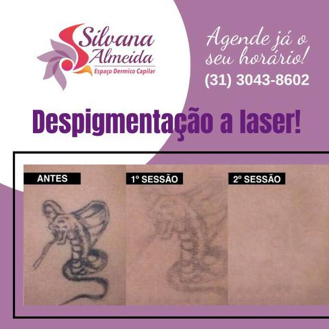 Remoção de Tatuagem à laser em Floripa apagar tatuagem em Floripa - Foto 4