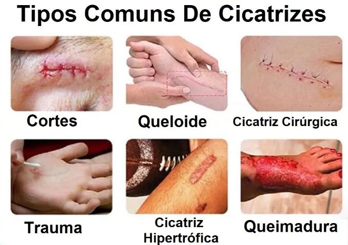 2Un. Gel Para Cicatrizes KeloCote - Foto 3