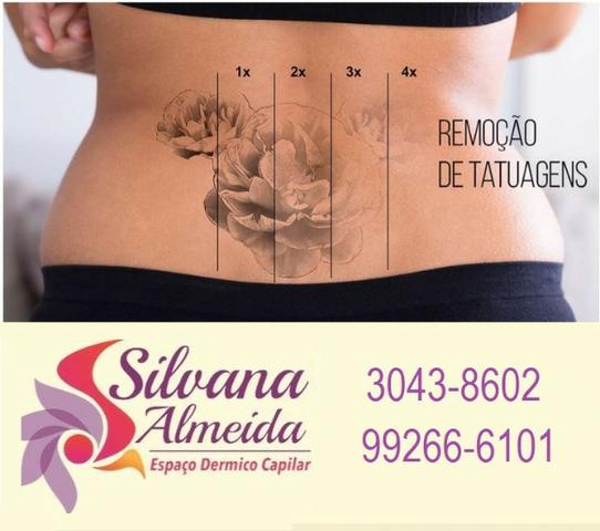 Remoção de Tatuagem à laser em Floripa apagar tatuagem em Floripa