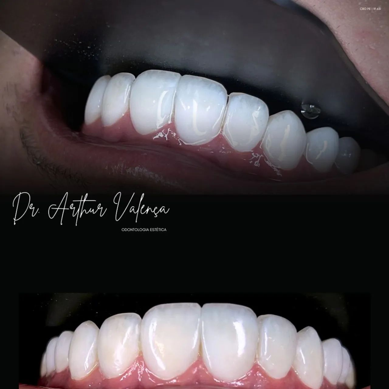 Facetas em Resina Premium
