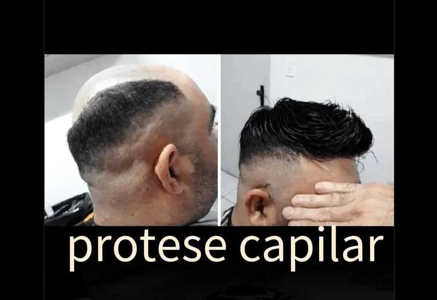 Prótese capilar  - Foto 3