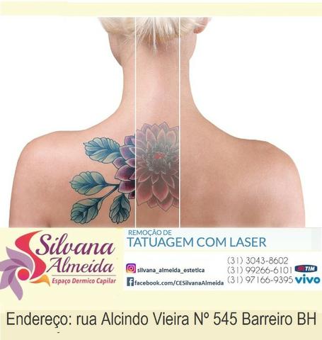 Remoção de Tatuagem à laser em Floripa apagar tatuagem em Floripa - Foto 5