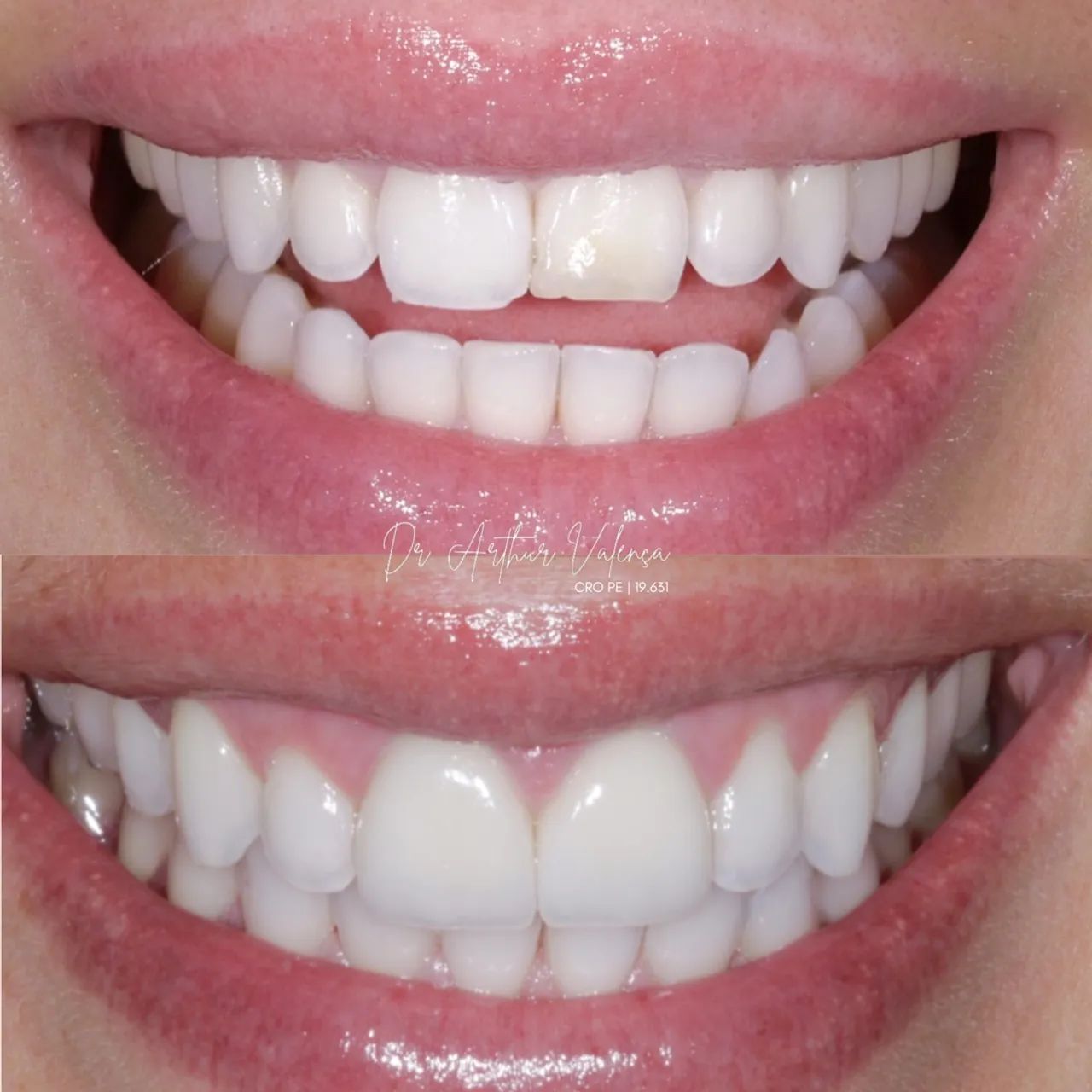Facetas em Resina Premium - Foto 3