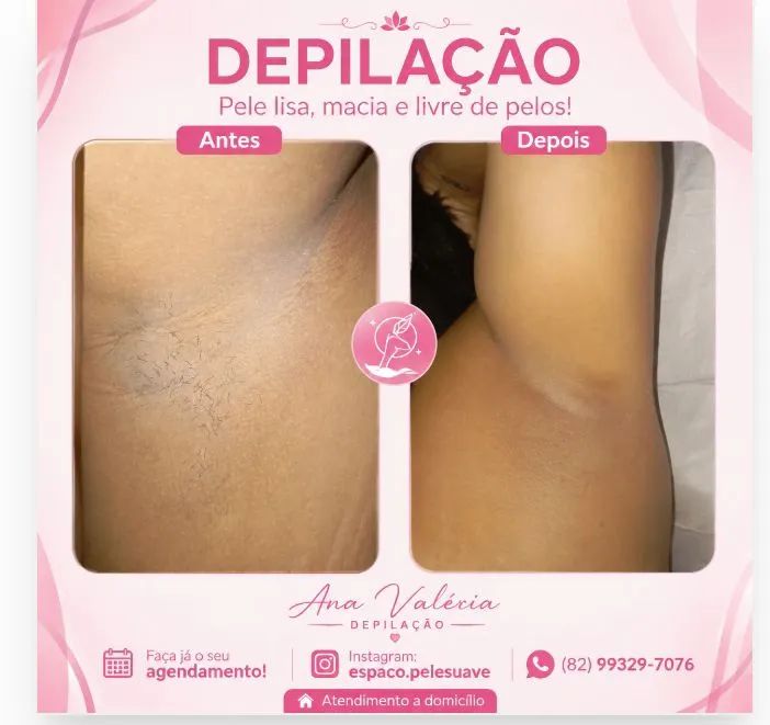 Depilação  - Foto 2