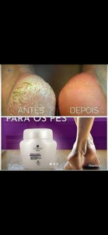 Antirachadura para os Pés  - Foto 3