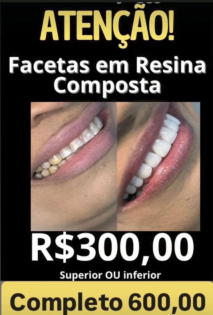 Facetas de Resina