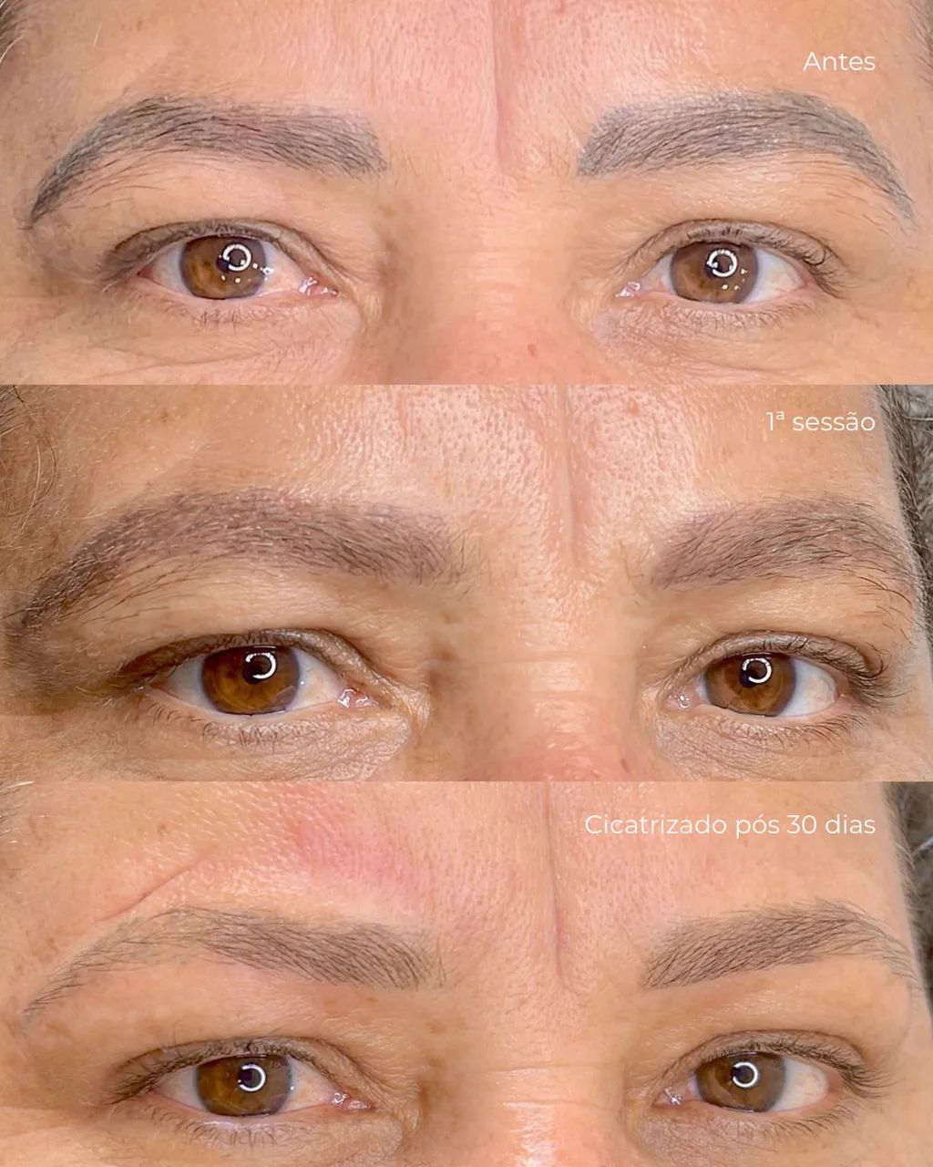 Remoção a laser de micropigmentação - Foto 2
