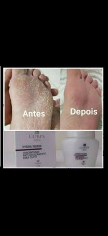 Antirachadura para os Pés  - Foto 4