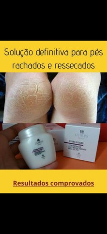 Antirachadura para os Pés  - Foto 2