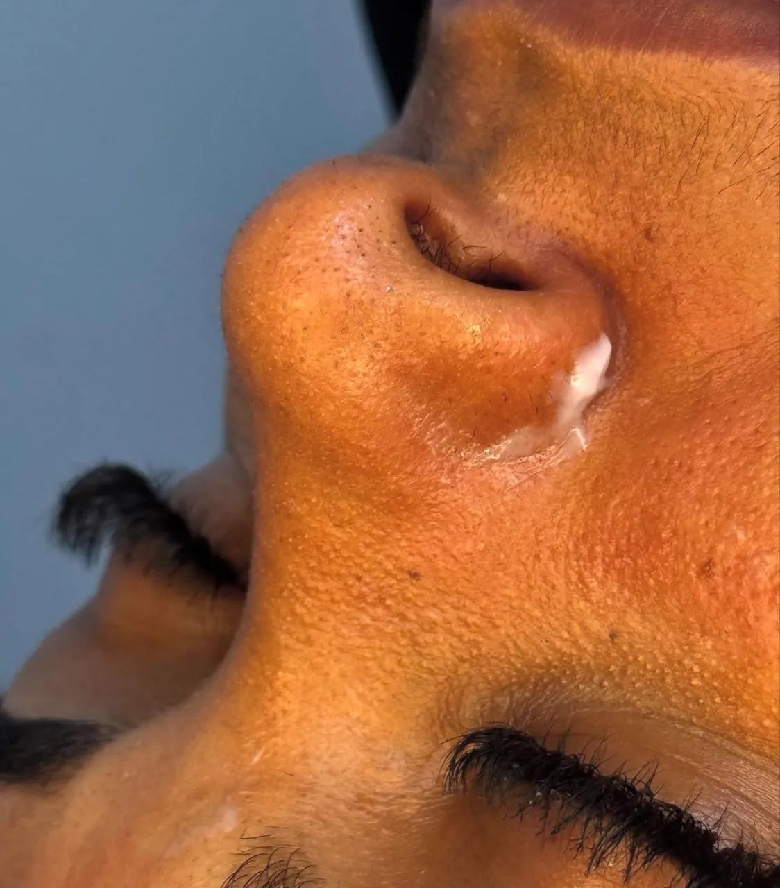 Limpeza de Pele Profunda - Foto 2