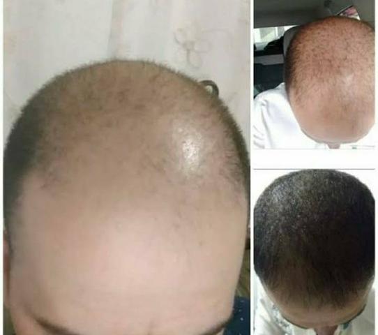 Produto para crescer barba, cabelos e sobrancelhas - Foto 4