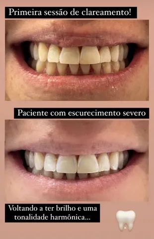  Clareamento dental laser 