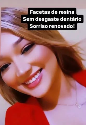 Facetas de resina  - Foto 2