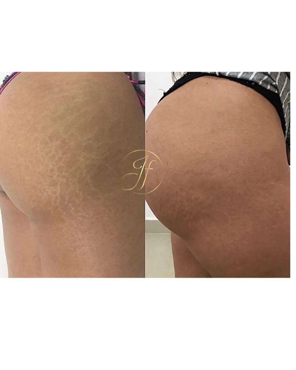 Tratamento de estrias com colágeno 