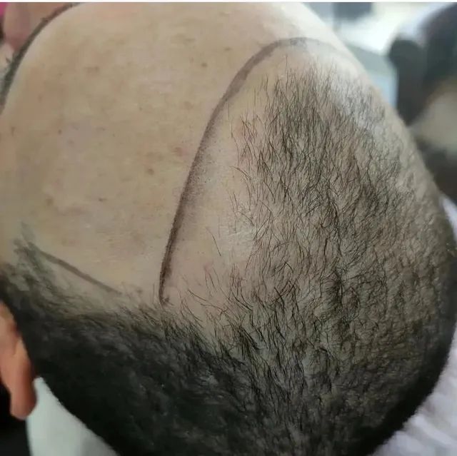 Micropigmentação capilar  - Foto 4