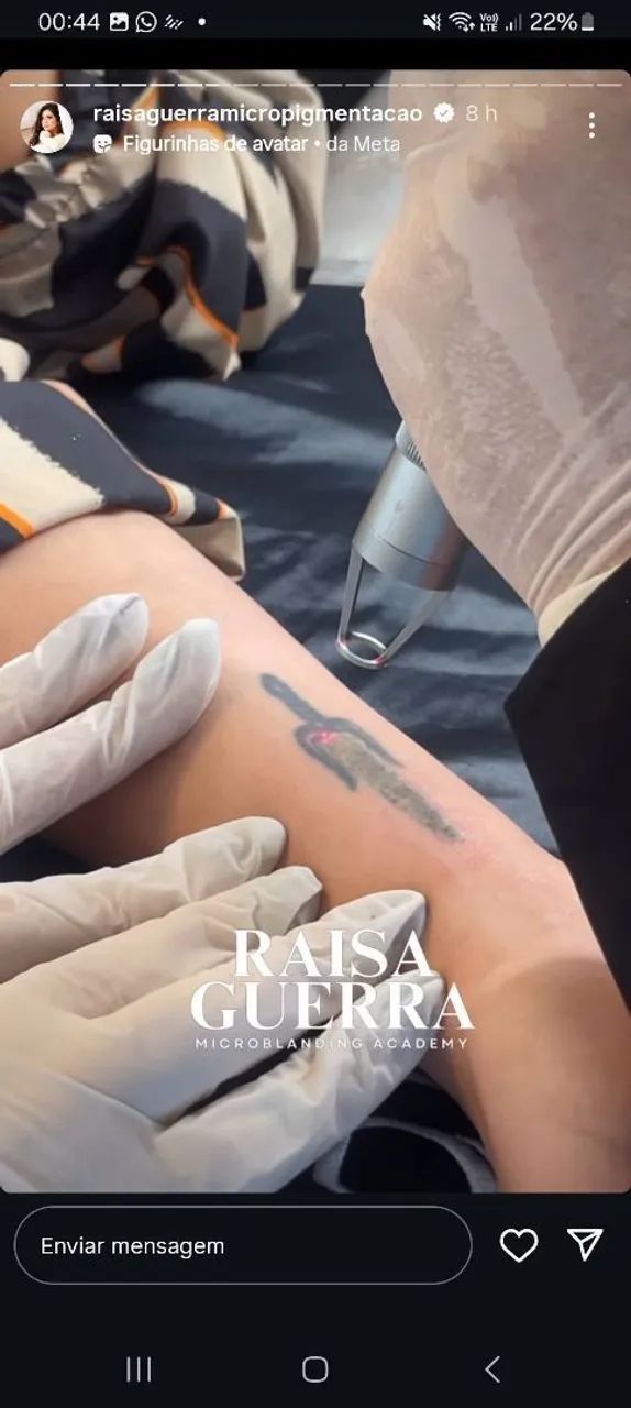 Remoção de tatuagem a lazer - Foto 2
