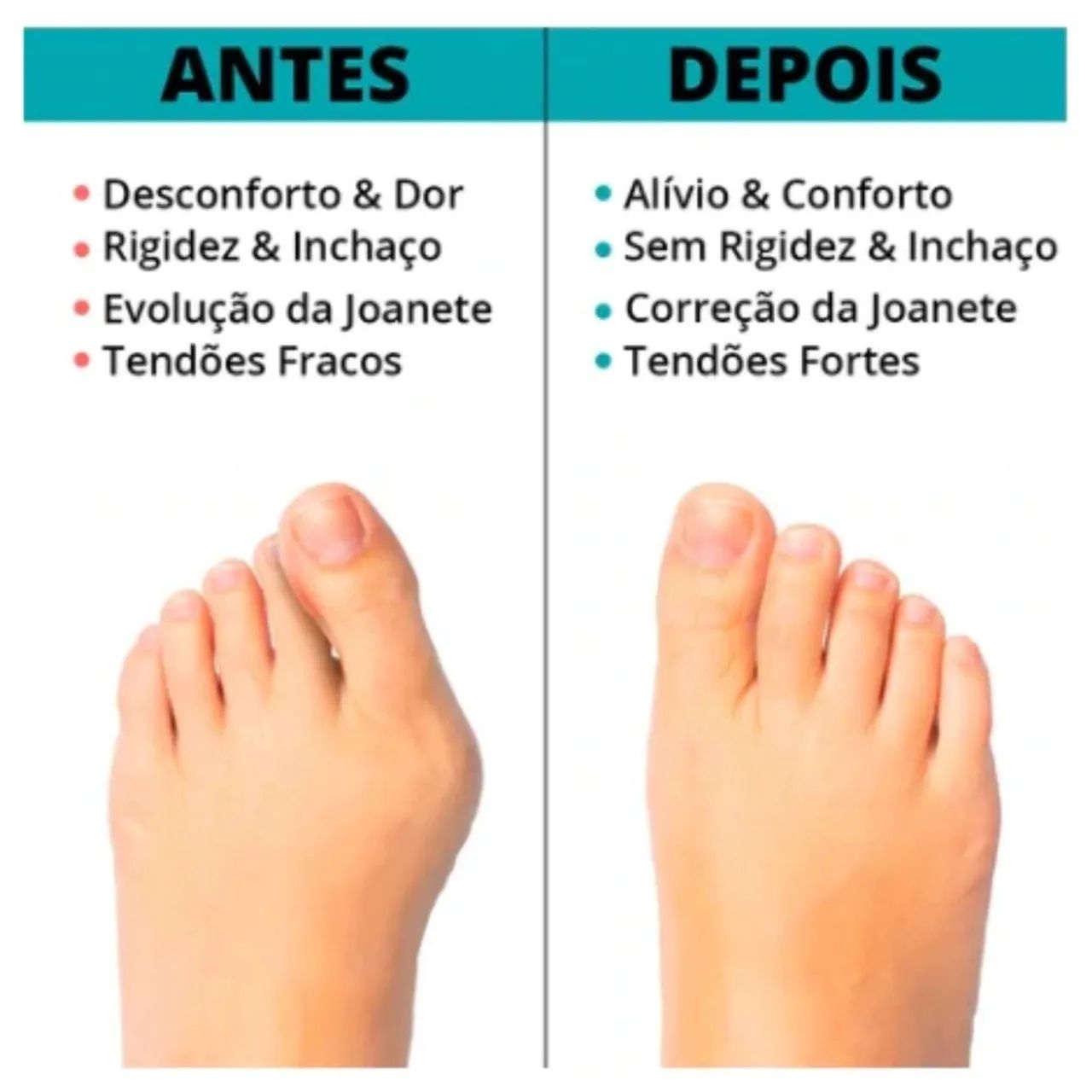 Correção de Hálux Valgo - Separador de Dedos - Foto 4