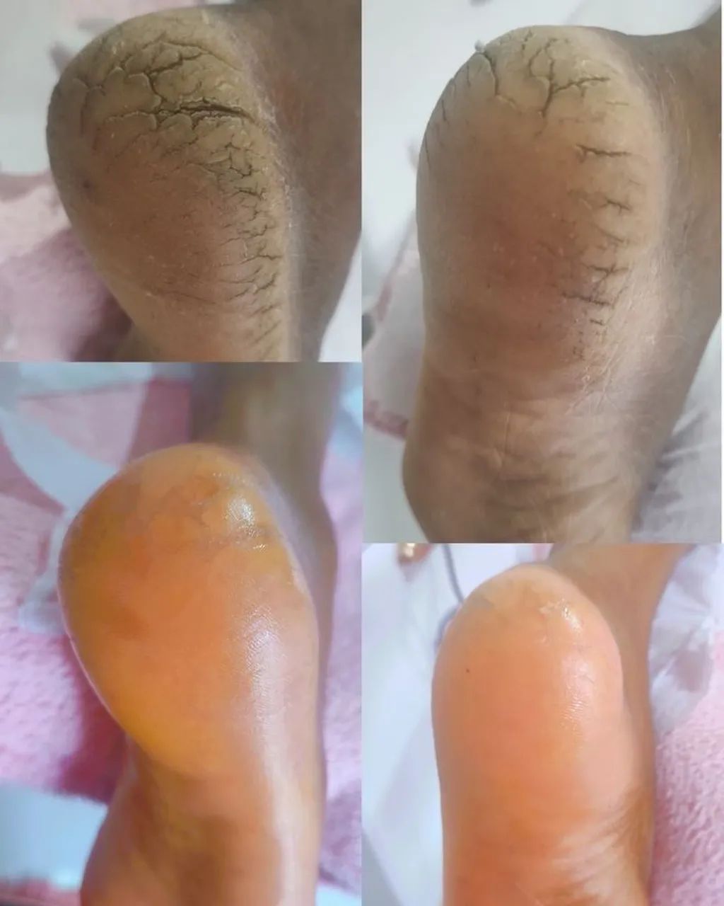 Spa do Pés (remoção de calosidade)