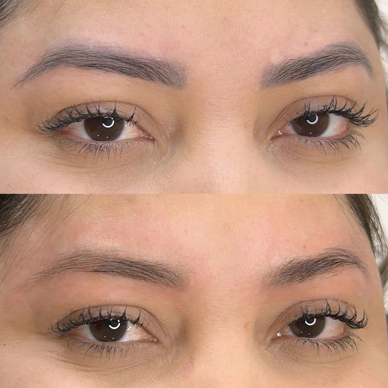 Remoção a laser de micropigmentação - Foto 3