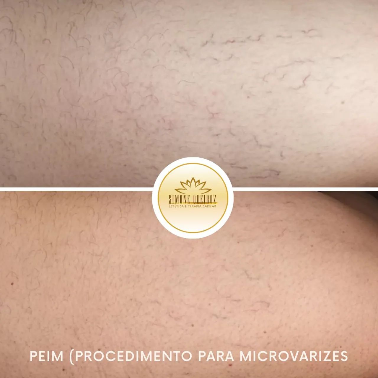 Tratamento para microvarizes  - Foto 2