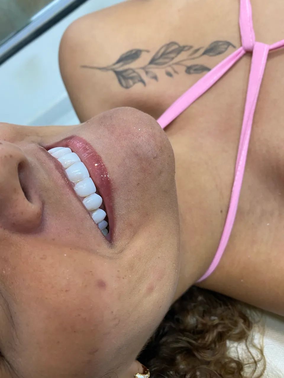 Facetas em resina 