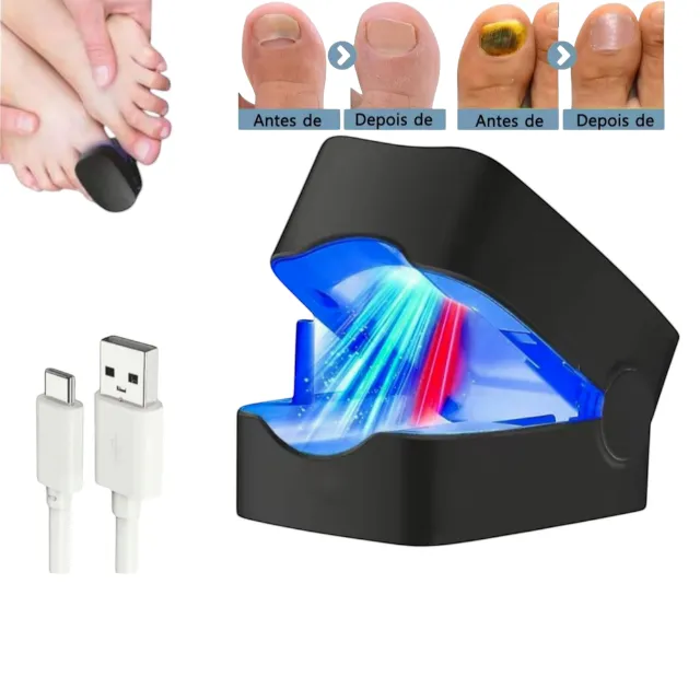 Aparelho a Laser Para Fungos Micoses Nas Unhas Portátil - Uso Doméstico