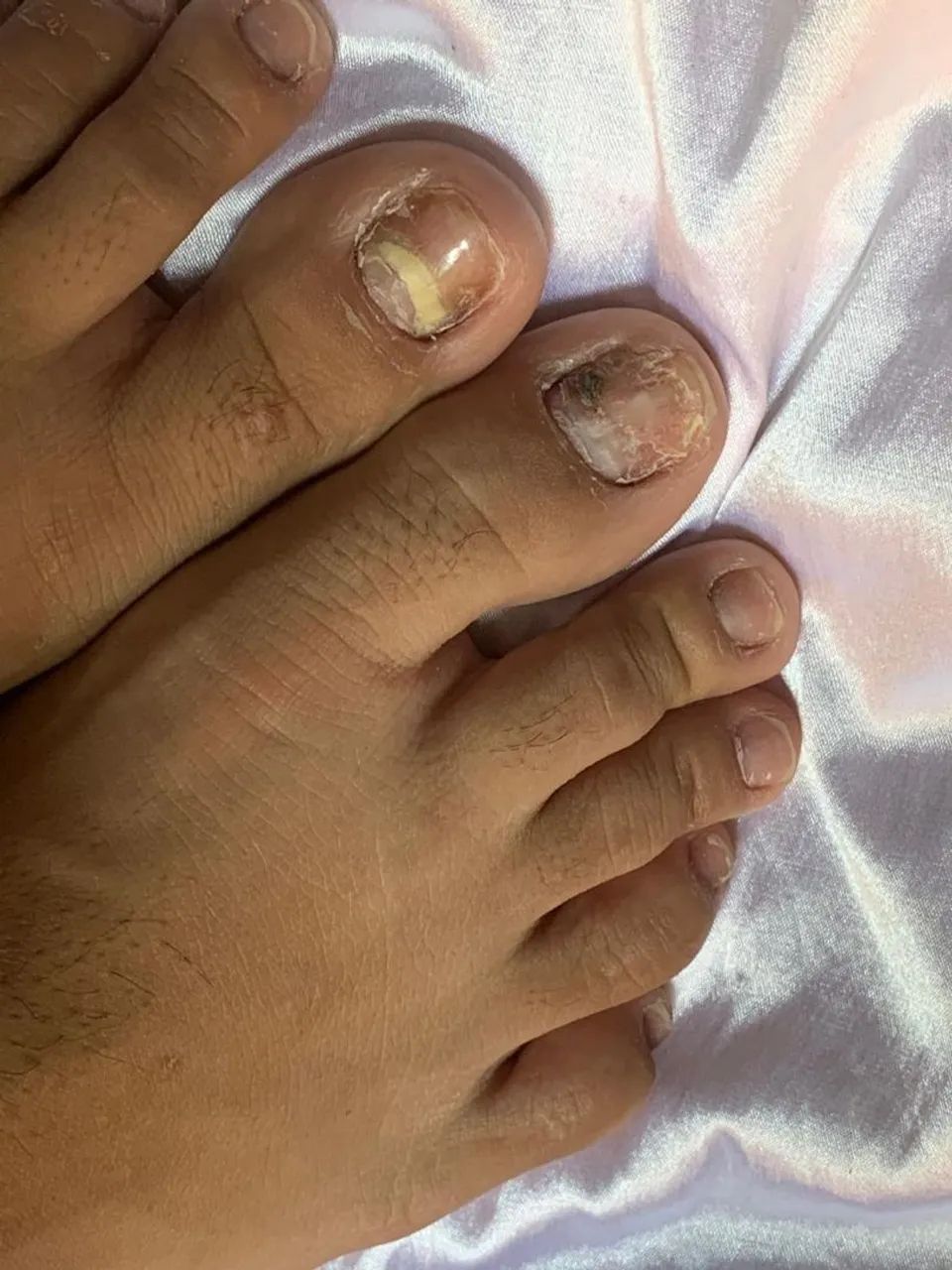 PEDICIRE+BLINDAGEM NAS UNHAS - Foto 2