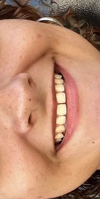 Facetas em resina  - Foto 2