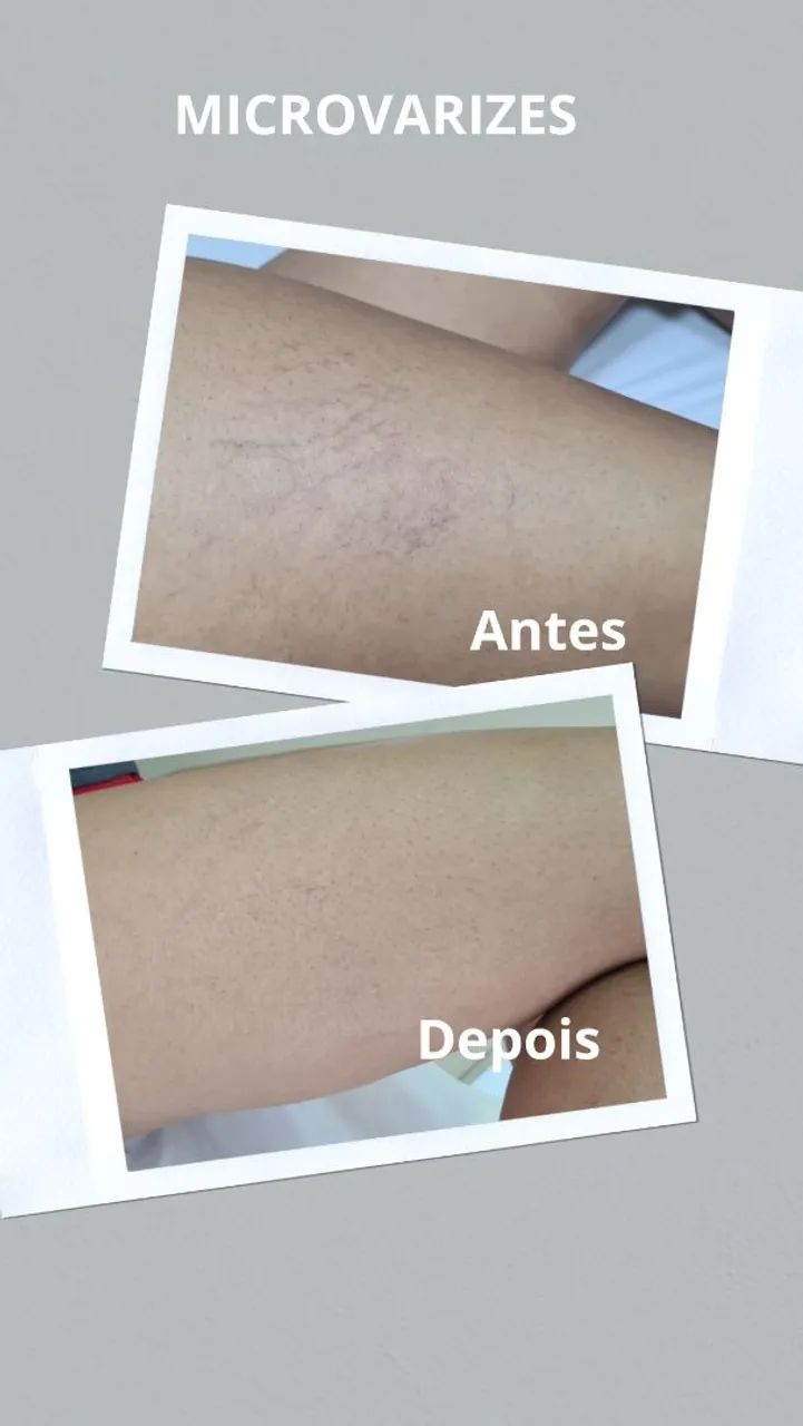 Tratamento para microvarizes  - Foto 4