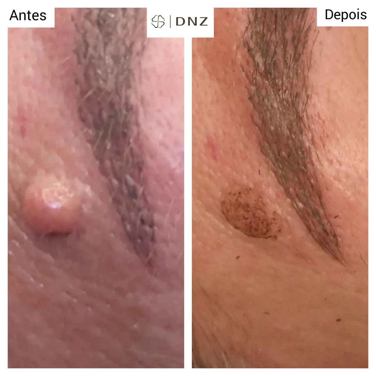 Remoção de verruga ou sinal pequeno  - Foto 3