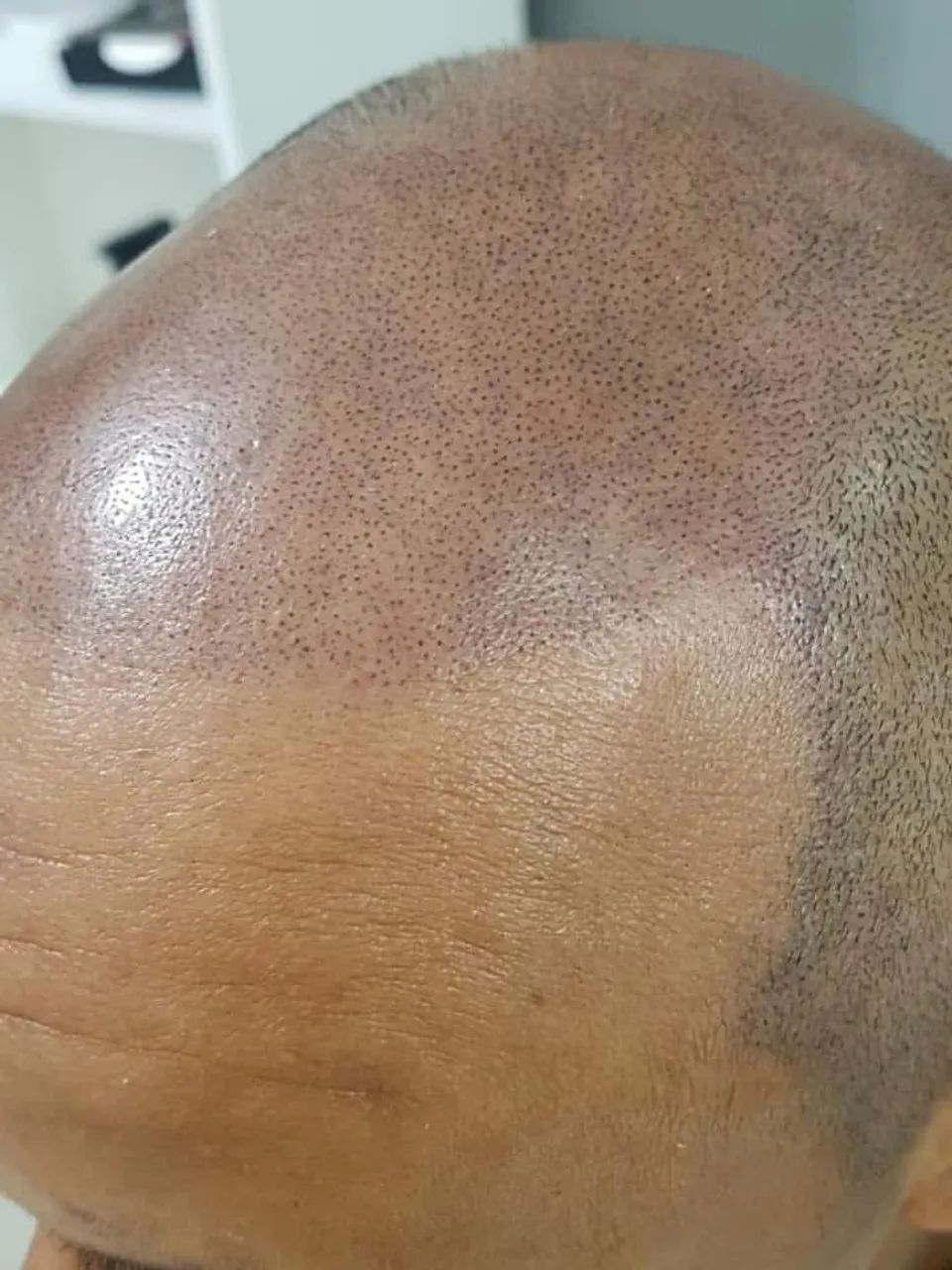 Micropigmentação capilar ao seu alcance