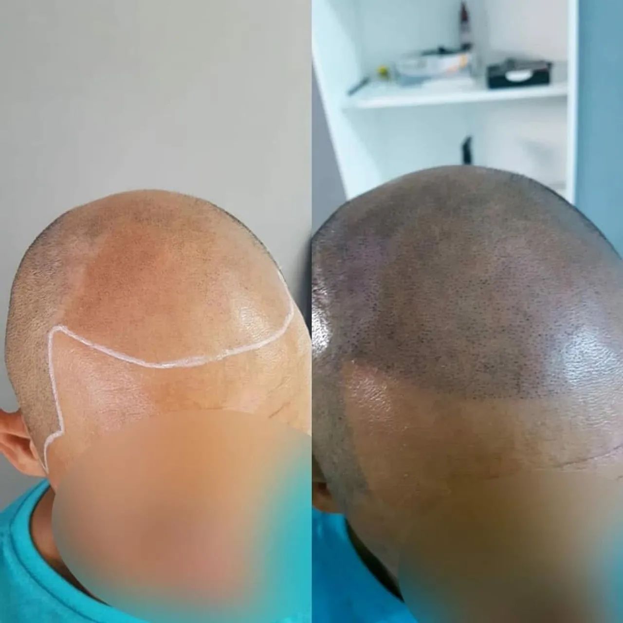 Micropigmentação capilar ao seu alcance - Foto 2